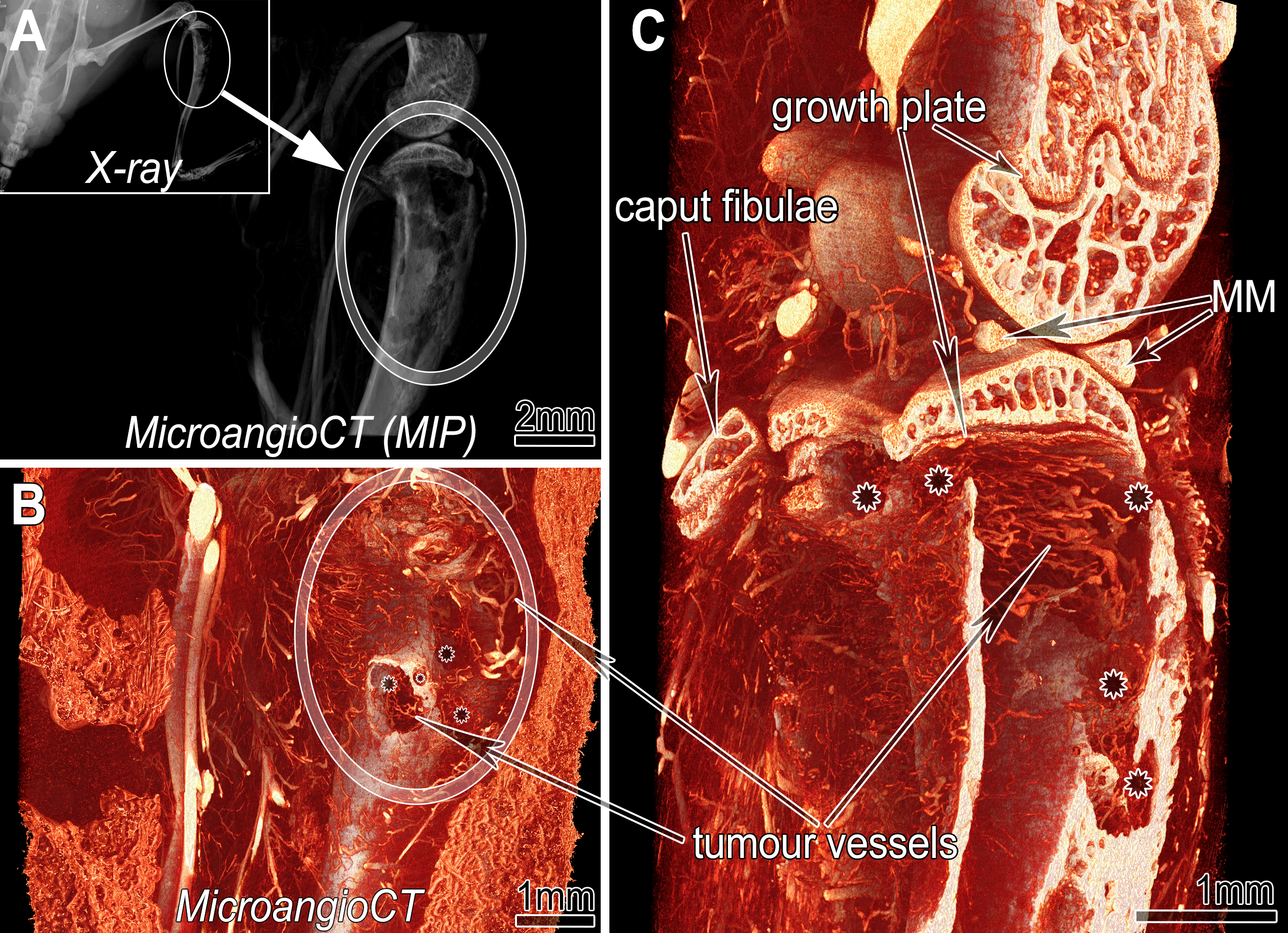 Figure 3: microAngioCT of a xenograft tumor implanted into tibia of 6-week-old CB17SCID male mice. A: Maximum intensity projection (MIP) of the three-dimensional dataset of the investigated hind limb segment indicated in the inserted X-ray image of the mouse prior to harvesting. Inset: X-ray image before sample harvesting. B: Virtual section through the microAngioCT dataset visualizing remarkable defects represented as holes (asterisks in B and C) in the tibial bone at the tumor site (encircled). C: A more deeply positioned virtual section displaying the inner surface of the diseased tibia. Besides irregularly patterned tumor vessels (in B & C) further bony structures like the growth plate or calcified parts of the medial meniscus (MM) are clearly distinguishable.